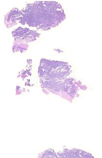 TCGA-AA-A02F-01Z-00-DX1.6E214530-87AE-4E9F-89A9-E35BA9C69BB0.svs