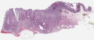 TCGA-CM-4751-01Z-00-DX1.F72E1883-5293-4351-A8DC-C4EA5D8F797C.svs