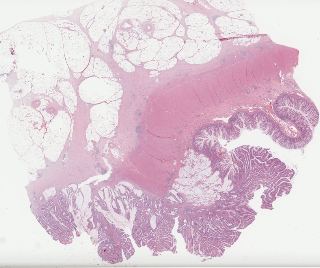 TCGA-G4-6322-01Z-00-DX1.8676af67-716a-4052-a5e7-024b2e29c492.svs