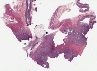 TCGA-AZ-6605-01Z-00-DX1.4d634c3e-a1c0-42e1-a4d6-5980eddfa0ca.svs
