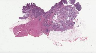 TCGA-CM-6165-01Z-00-DX1.d59faefa-f647-4617-9dcf-4fd6ab45b4e6.svs
