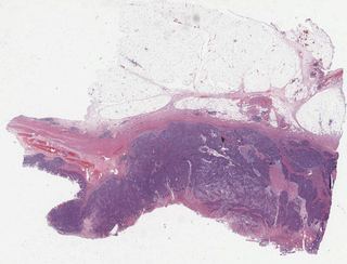 TCGA-AZ-6598-01Z-00-DX1.1fc4cd61-4524-413b-b36d-ad438785bc06.svs